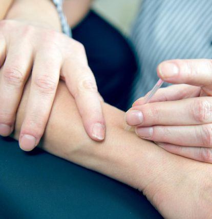 acupuncture on woman